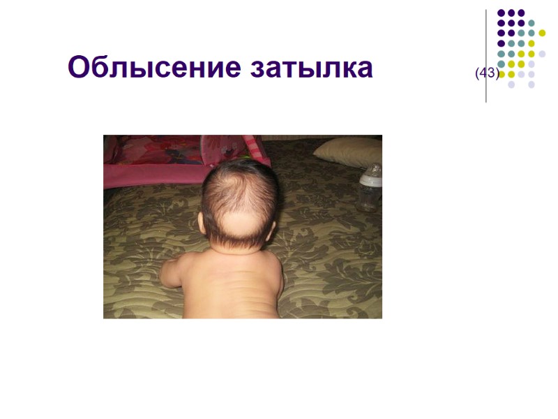 Облысение затылка            (43)